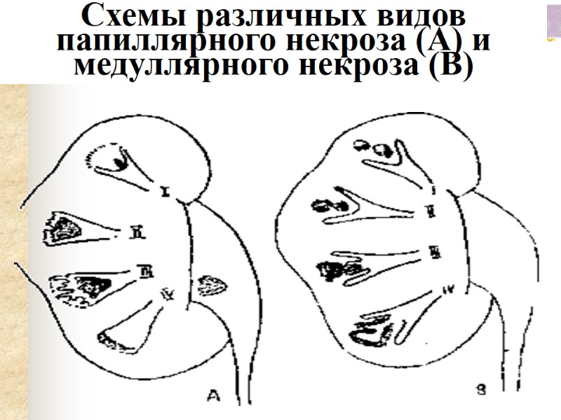 Схемы различных видов папиллярного некроза (А) и медуллярного некроза (В)